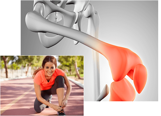 A digital illustration of a human hip joint with inflammation, alongside a woman tying her shoe before a run