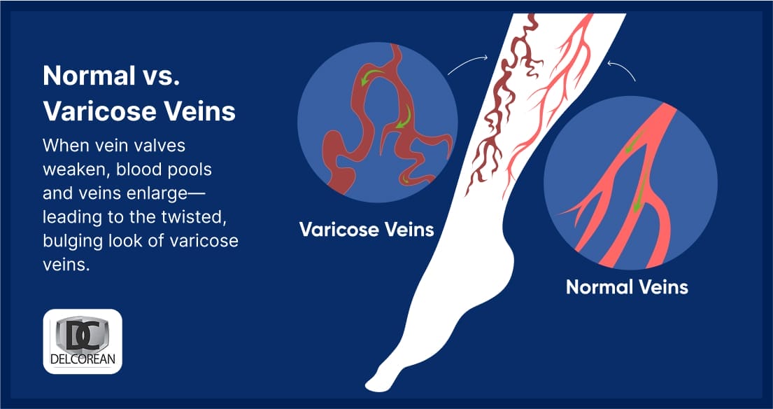 Normal vs Vericose veins